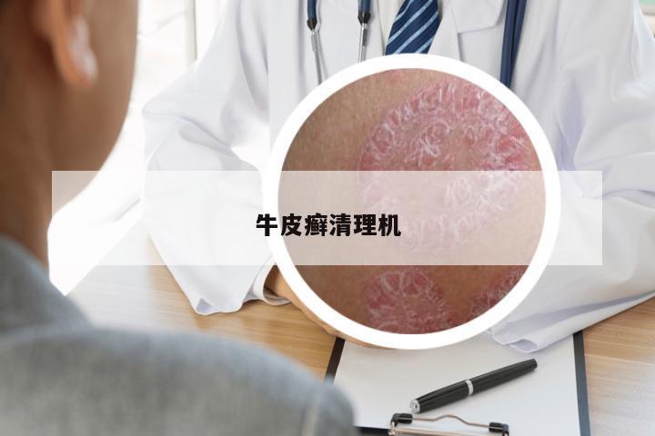 牛皮癬清理機
