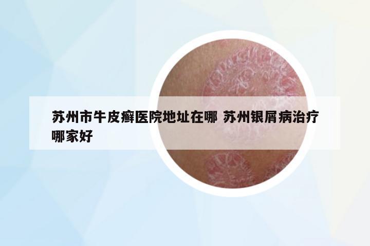 蘇州市牛皮癬醫(yī)院地址在哪 蘇州銀屑病治療哪家好