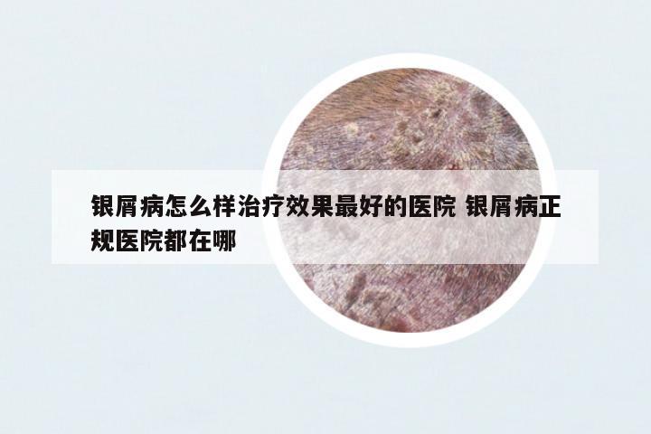 銀屑病怎么樣治療效果最好的醫(yī)院 銀屑病正規(guī)醫(yī)院都在哪