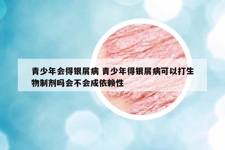 青少年會得銀屑病 青少年得銀屑病可以打生物制劑嗎會不會成依賴性