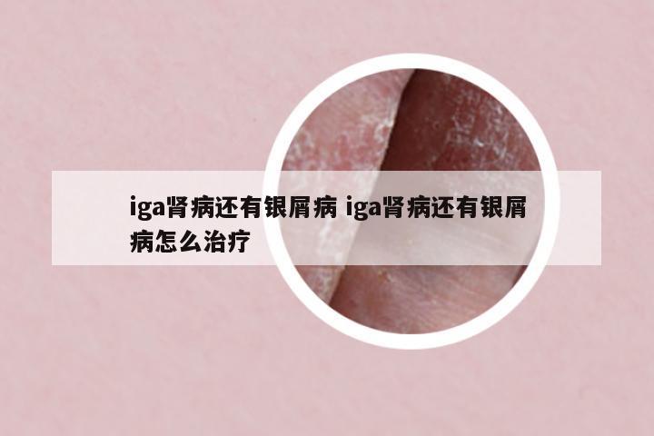 iga腎病還有銀屑病 iga腎病還有銀屑病怎么治療