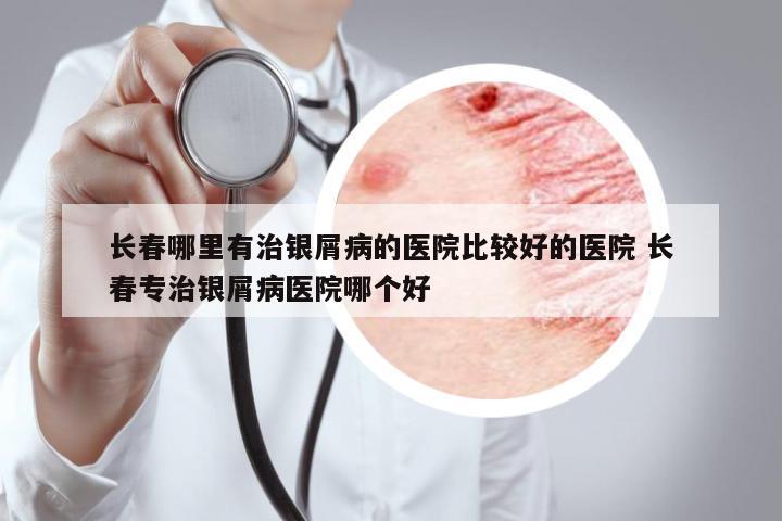 長(zhǎng)春哪里有治銀屑病的醫(yī)院比較好的醫(yī)院 長(zhǎng)春專治銀屑病醫(yī)院哪個(gè)好
