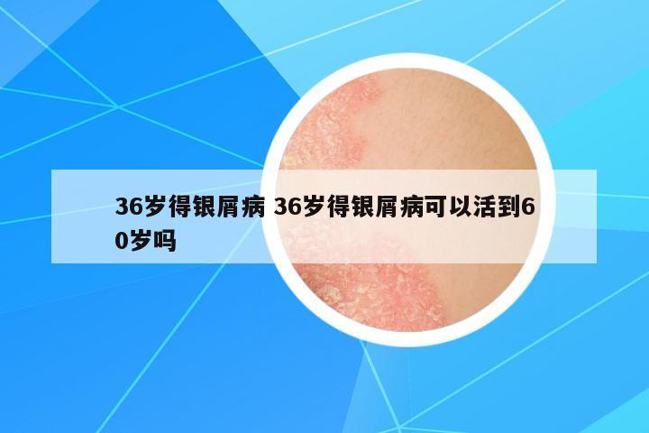36歲得銀屑病 36歲得銀屑病可以活到60歲嗎