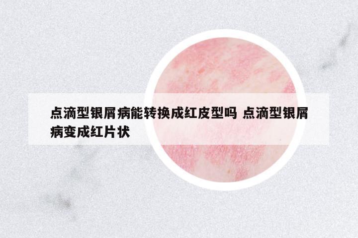 點(diǎn)滴型銀屑病能轉(zhuǎn)換成紅皮型嗎 點(diǎn)滴型銀屑病變成紅片狀