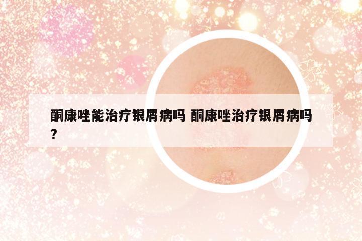 酮康唑能治療銀屑病嗎 酮康唑治療銀屑病嗎?