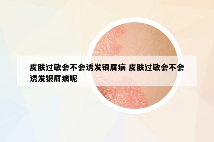 皮膚過(guò)敏會(huì)不會(huì)誘發(fā)銀屑病 皮膚過(guò)敏會(huì)不會(huì)誘發(fā)銀屑病呢
