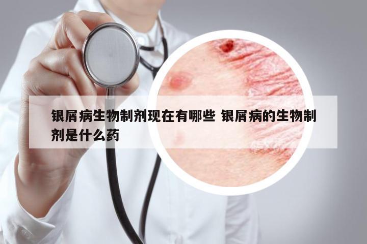 銀屑病生物制劑現(xiàn)在有哪些 銀屑病的生物制劑是什么藥