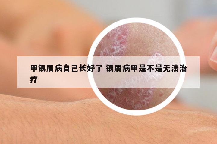 甲銀屑病自己長好了 銀屑病甲是不是無法治療