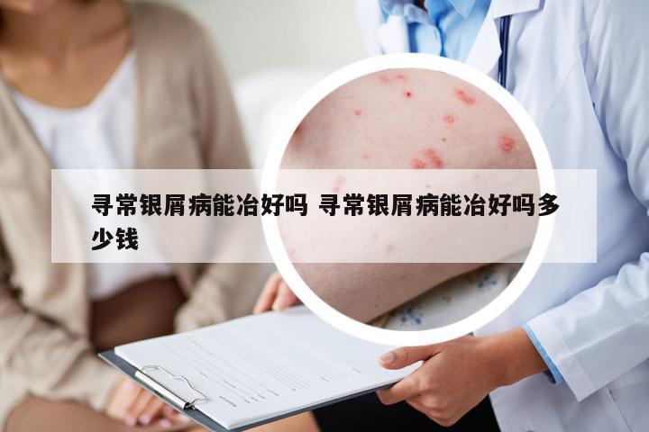尋常銀屑病能冶好嗎 尋常銀屑病能冶好嗎多少錢