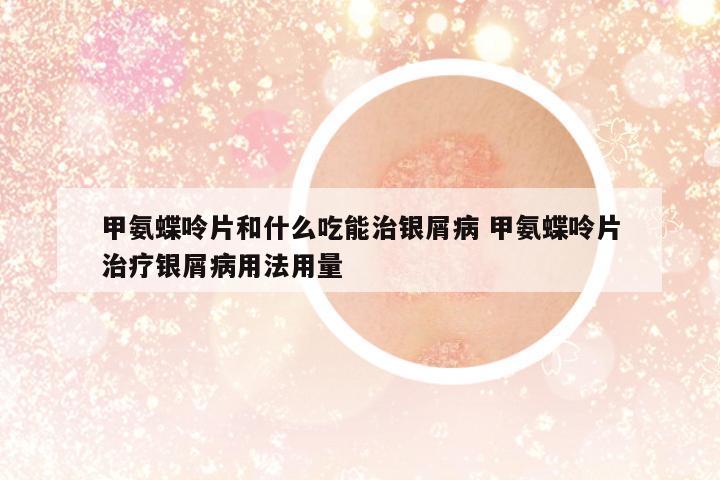 甲氨蝶呤片和什么吃能治銀屑病 甲氨蝶呤片治療銀屑病用法用量
