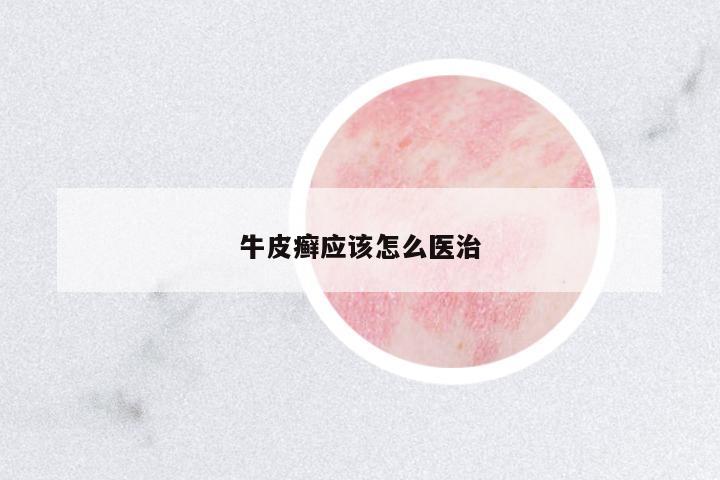 牛皮癬應(yīng)該怎么醫(yī)治