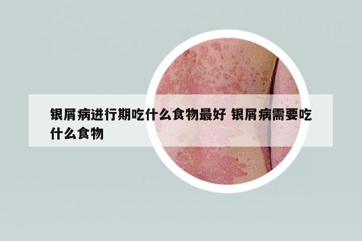 銀屑病進(jìn)行期吃什么食物最好 銀屑病需要吃什么食物