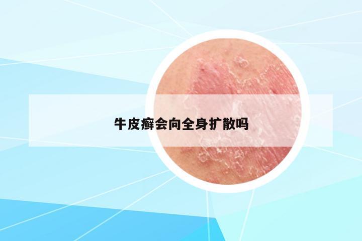 牛皮癬會(huì)向全身擴(kuò)散嗎
