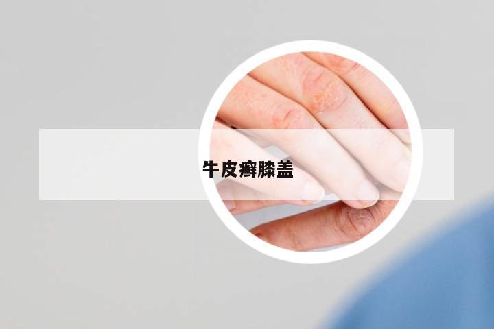牛皮癬膝蓋