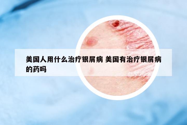 美國(guó)人用什么治療銀屑病 美國(guó)有治療銀屑病的藥嗎