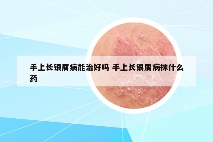 手上長銀屑病能治好嗎 手上長銀屑病抹什么藥
