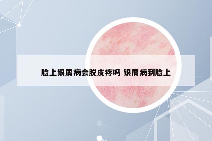 臉上銀屑病會脫皮疼嗎 銀屑病到臉上