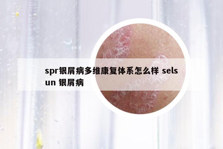 spr銀屑病多維康復(fù)體系怎么樣 selsun 銀屑病