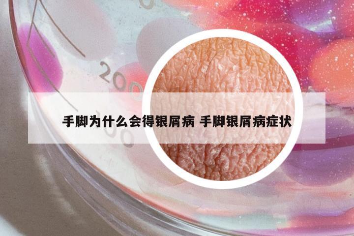 手腳為什么會得銀屑病 手腳銀屑病癥狀