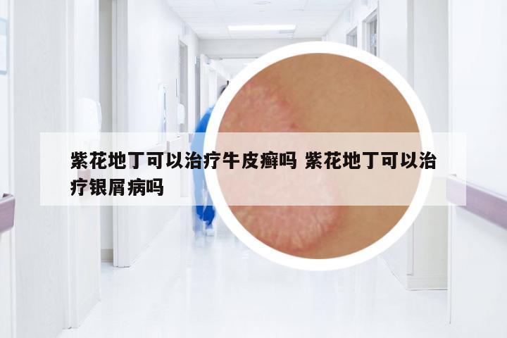 紫花地丁可以治療牛皮癬嗎 紫花地丁可以治療銀屑病嗎