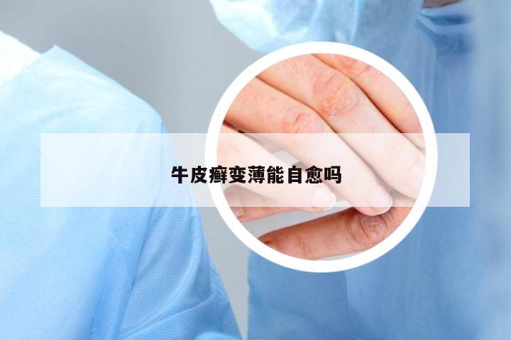 牛皮癬變薄能自愈嗎