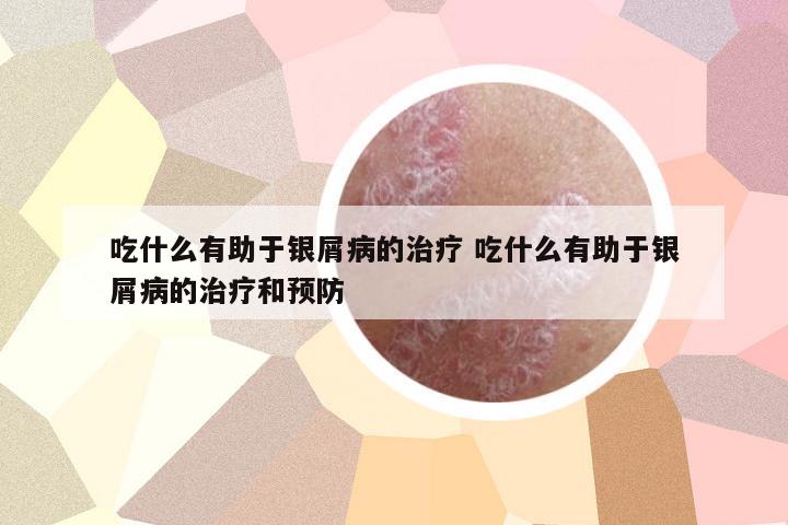 吃什么有助于銀屑病的治療 吃什么有助于銀屑病的治療和預(yù)防
