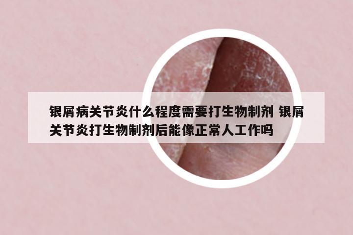 銀屑病關(guān)節(jié)炎什么程度需要打生物制劑 銀屑關(guān)節(jié)炎打生物制劑后能像正常人工作嗎