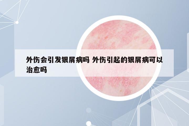外傷會(huì)引發(fā)銀屑病嗎 外傷引起的銀屑病可以治愈嗎