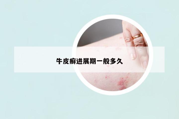 牛皮癬進(jìn)展期一般多久