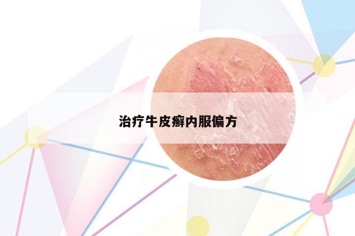 治療牛皮癬內(nèi)服偏方