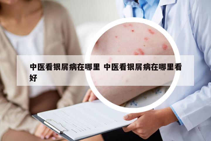 中醫(yī)看銀屑病在哪里 中醫(yī)看銀屑病在哪里看好