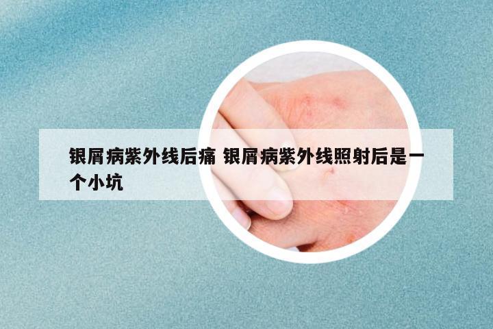 銀屑病紫外線后痛 銀屑病紫外線照射后是一個(gè)小坑