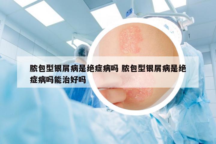 膿包型銀屑病是絕癥病嗎 膿包型銀屑病是絕癥病嗎能治好嗎