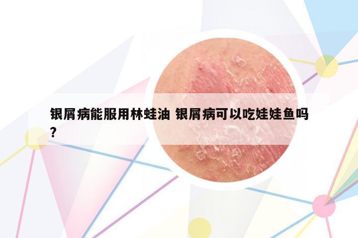 銀屑病能服用林蛙油 銀屑病可以吃娃娃魚嗎?
