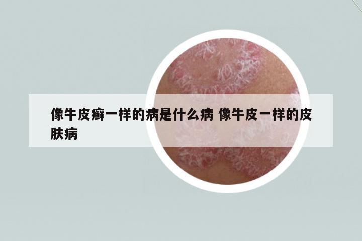 像牛皮癬一樣的病是什么病 像牛皮一樣的皮膚病