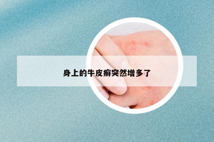 身上的牛皮癬突然增多了