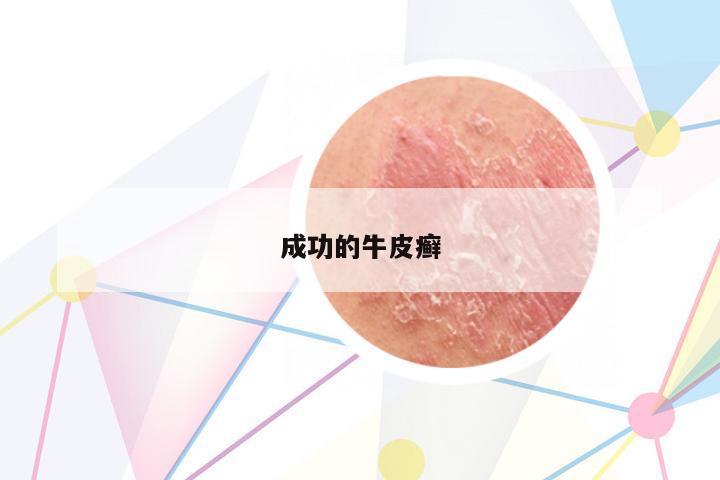 成功的牛皮癬