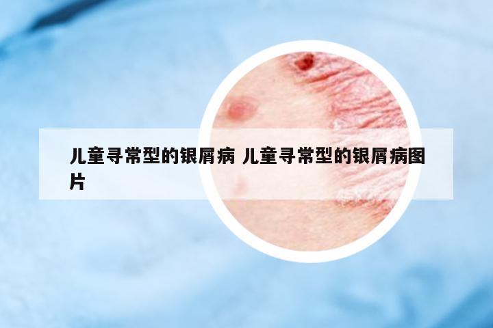 兒童尋常型的銀屑病 兒童尋常型的銀屑病圖片