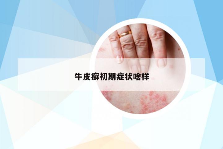 牛皮癬初期癥狀啥樣