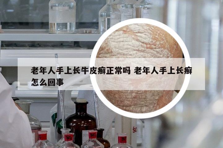 老年人手上長牛皮癬正常嗎 老年人手上長癬怎么回事