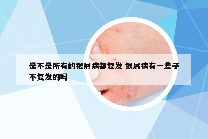 是不是所有的銀屑病都復(fù)發(fā) 銀屑病有一輩子不復(fù)發(fā)的嗎
