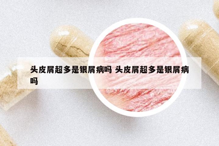 頭皮屑超多是銀屑病嗎 頭皮屑超多是銀屑病嗎