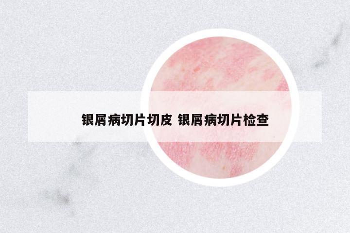 銀屑病切片切皮 銀屑病切片檢查