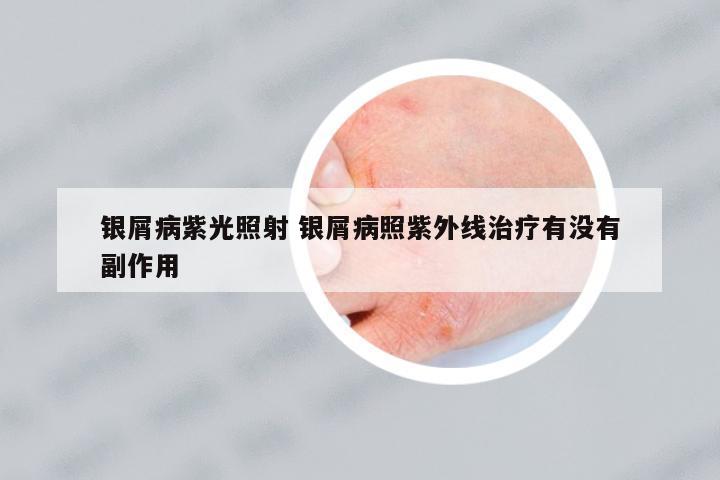 銀屑病紫光照射 銀屑病照紫外線治療有沒有副作用