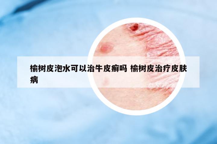 榆樹皮泡水可以治牛皮癬嗎 榆樹皮治療皮膚病