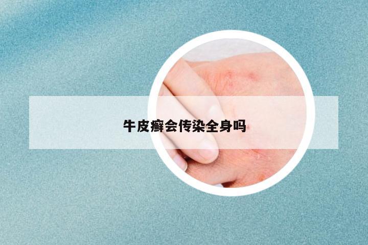 牛皮癬會(huì)傳染全身嗎