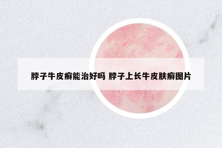 脖子牛皮癬能治好嗎 脖子上長(zhǎng)牛皮膚癬圖片
