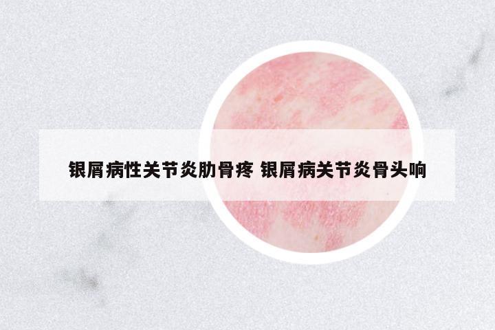 銀屑病性關(guān)節(jié)炎肋骨疼 銀屑病關(guān)節(jié)炎骨頭響