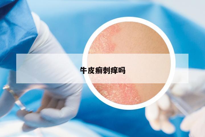 牛皮癬刺癢嗎