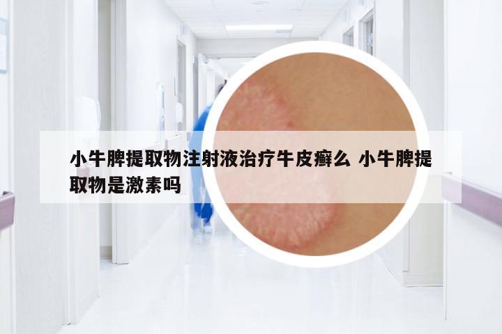 小牛脾提取物注射液治療牛皮癬么 小牛脾提取物是激素嗎